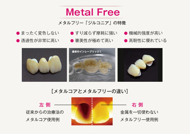 Metal Free